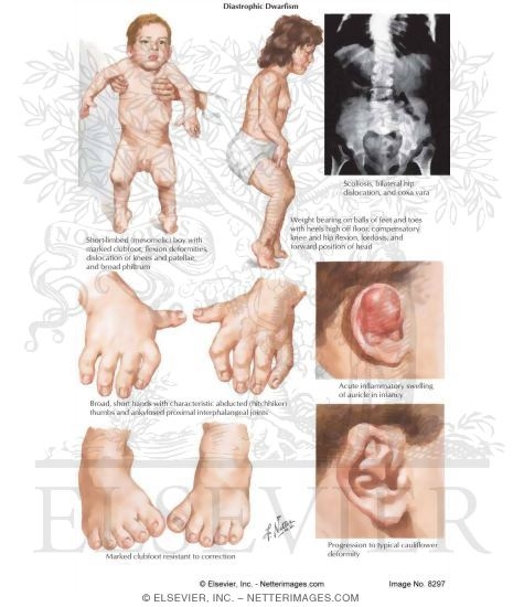 Diastrophic Dwarfism