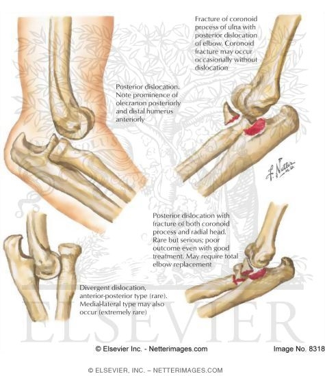Dislocation of Elbow Joint