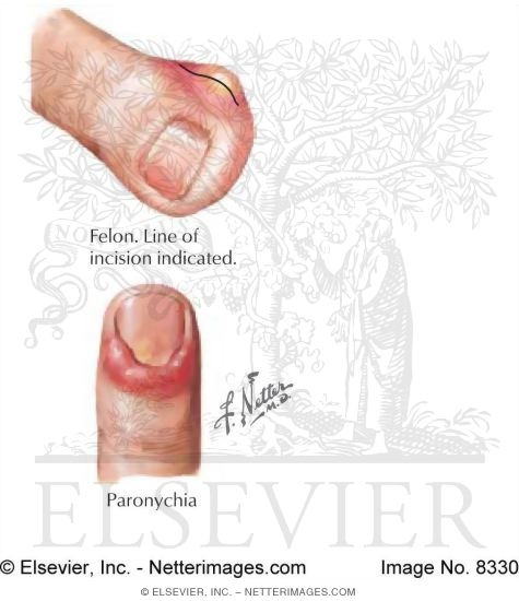 paronychia finger infection