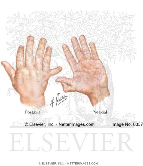 what is the life span of polydactyly in people
