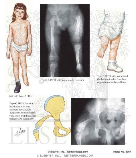 Illustration of Proximal Femoral Focal Deficiency (PFFD) from the Netter Collection