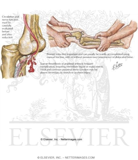 Dislocation of the Knee