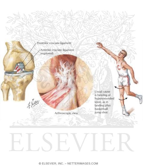 Rupture of the Anterior Cruciate Ligament