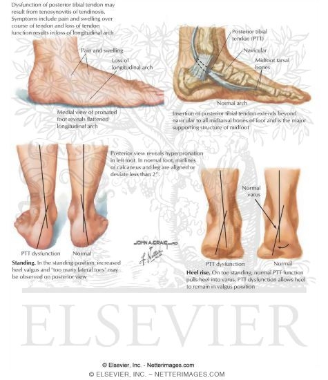 Artwork - Posterior Tibial