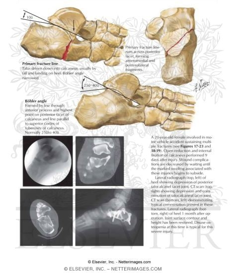 Intraarticular Fracture of the Calcaneus