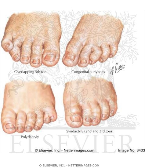 Polydactyly, Syndactyly, Congenital Curly Toe, and Overlapping Fifth Toe