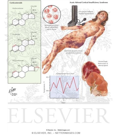 Acute Adrenal Insufficiency (Waterhouse-Friderichsen Syndrome)