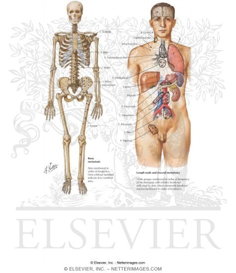Prostate Cancer: Metastases
