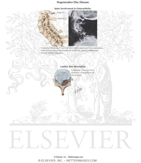 Degenerative Disc Disease