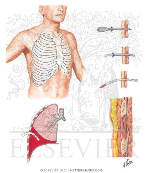 Chest Drainage Tube Placement