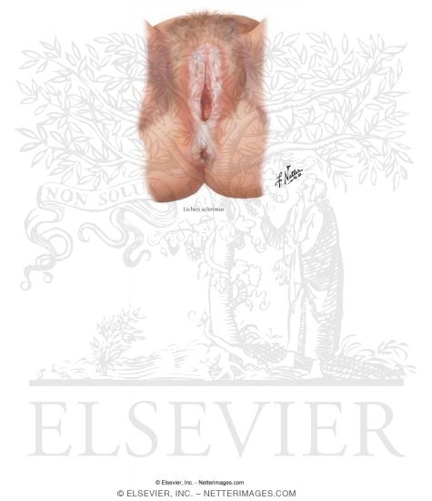 Lichen Sclerosus Lichen Sclerosus