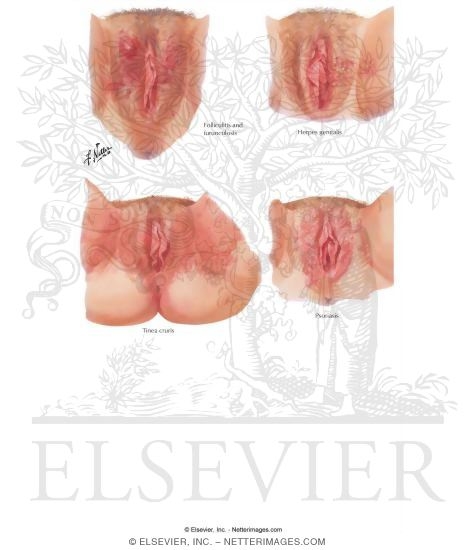 Vulvar Lesions