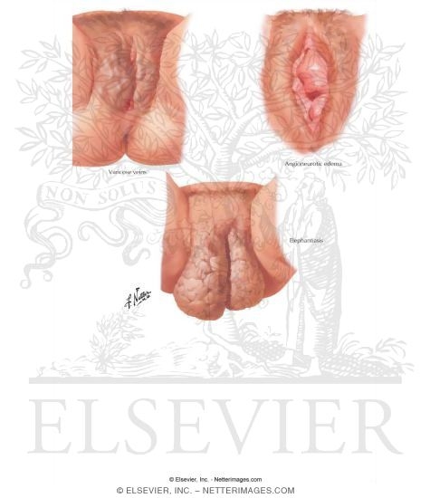 Vulvar Lesions