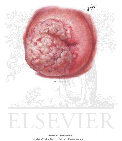 Cervical Cancer