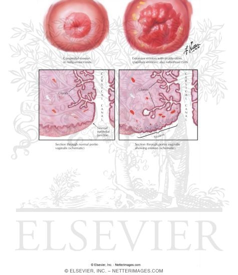 Cervical Erosion The preview images do not contain enough pixels to make 