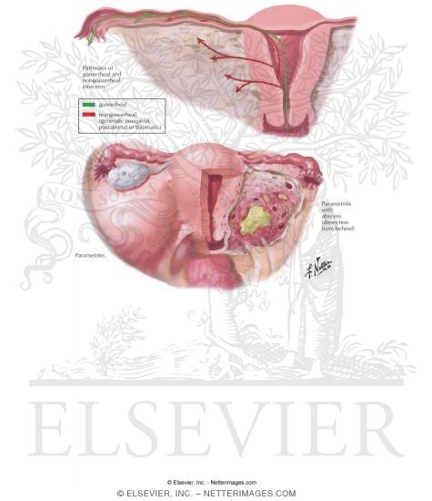 Endometritis