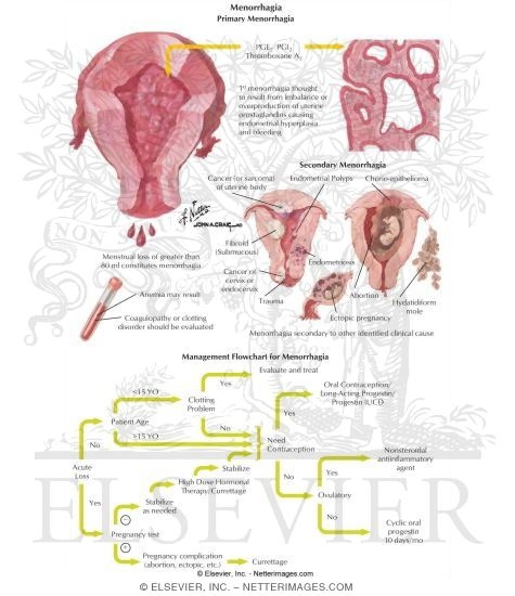 Menorrhagia