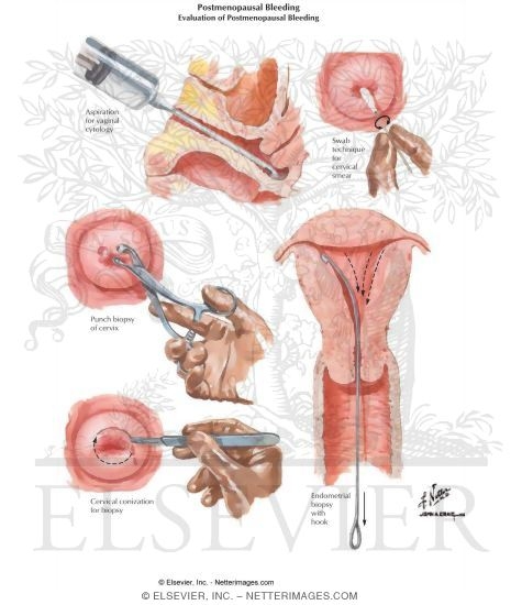 Postmenopausal Vaginal Bleeding