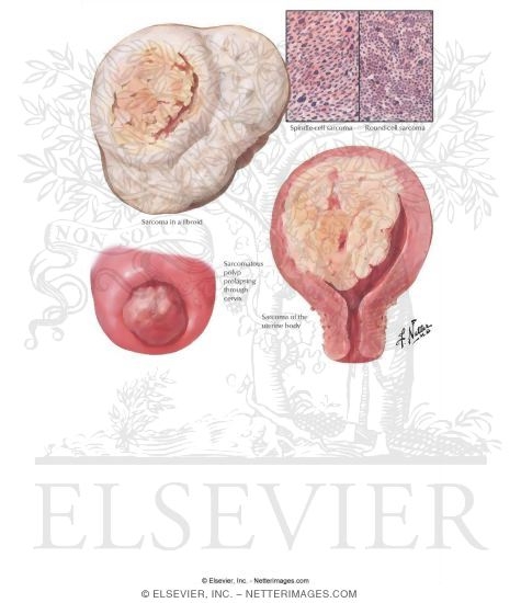 Uterine Sarcoma