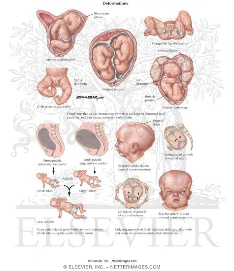 Breech Birth