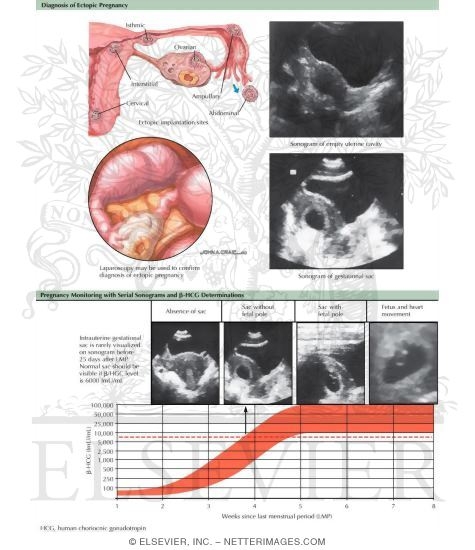 Diagnosis of Ectopic Pregnancy
