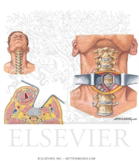 Anterior Approach to Cervical Spine