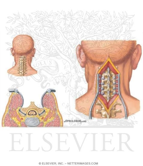 Posterior Approach to Cervical Spine