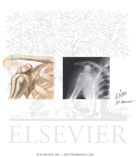 Subcoracoid Dislocation