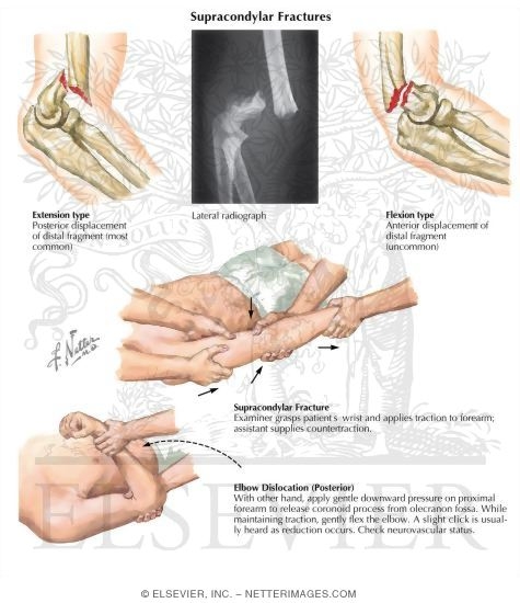 Trauma to the Arm