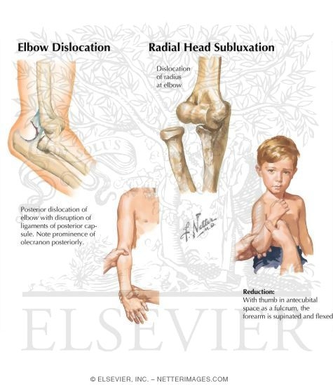 Elbow Dislocation
Radial Head Subluxation