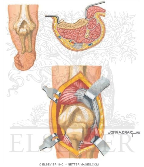 Surgical Approaches to the Elbow