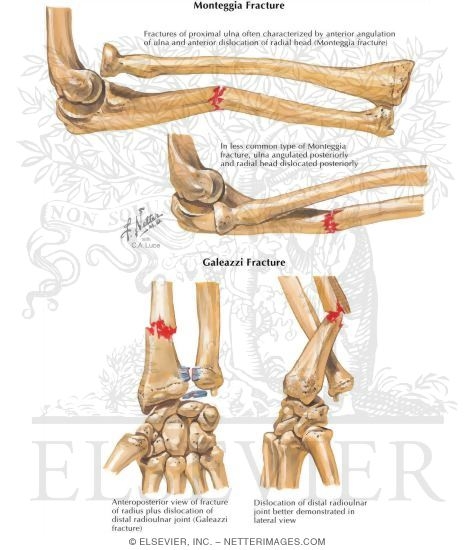 Monteggia Fracture
Galeazzi Fracture