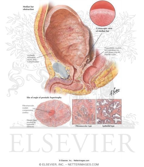 Benign Prostatic Hypertrophy I - Histologic Structure, Median Bar
