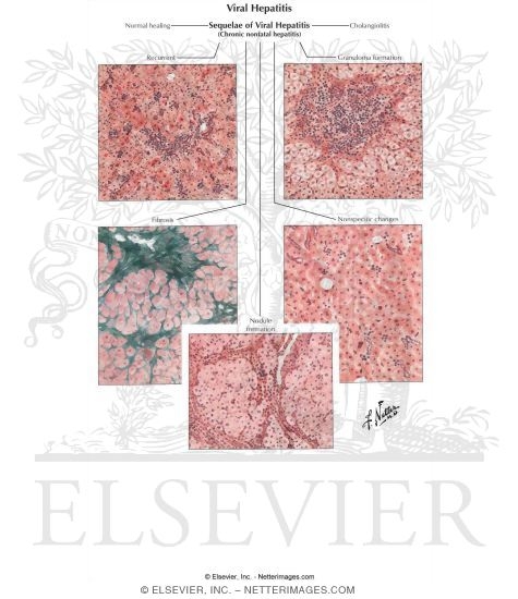 Viral Hepatitis IV - Sequelae of Hepatitis (Chronic Nonfatal Hepatitis)