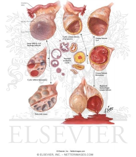 Diseases of the Ovary: