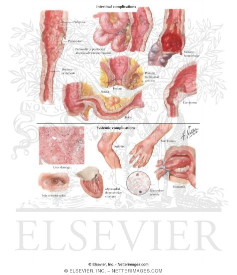 Ulcerative Colitis