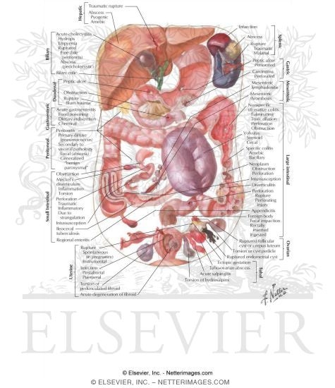 Acute Abdomen: Visceral Etiology