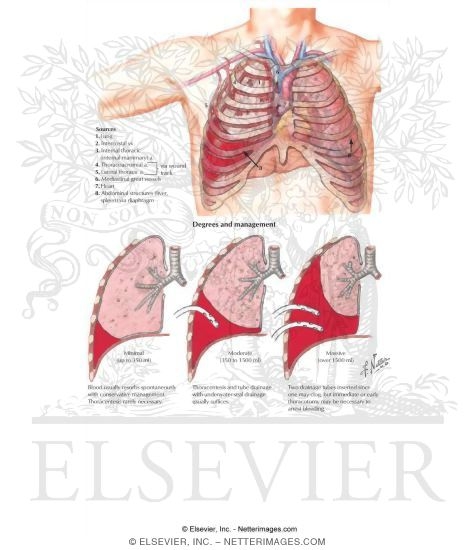 Hemothorax
