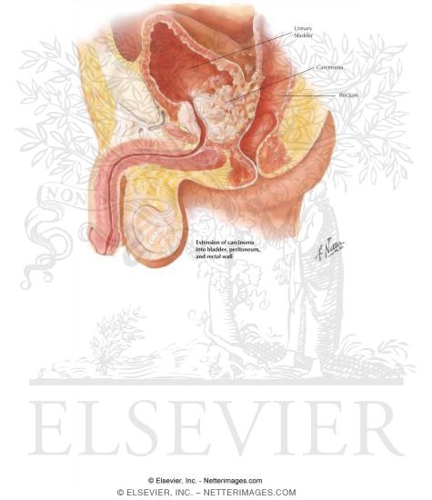 Carcinoma of Prostate I - Types and Extension