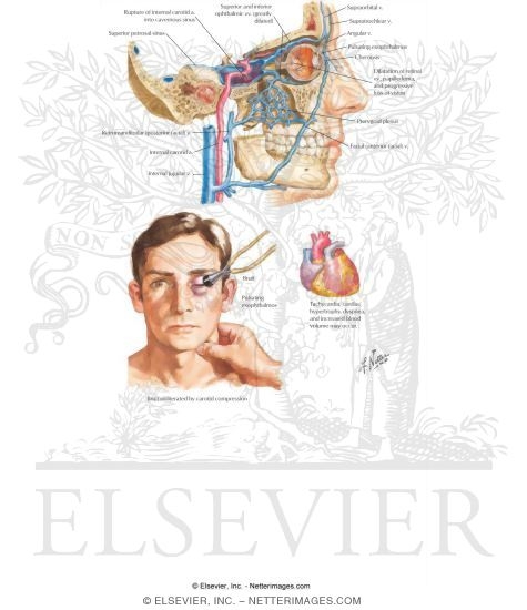 Carotid-Cavernous Arteriovenous Fistula