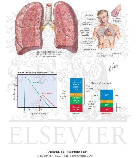 Idiopathic Pulmonary Fibrosis