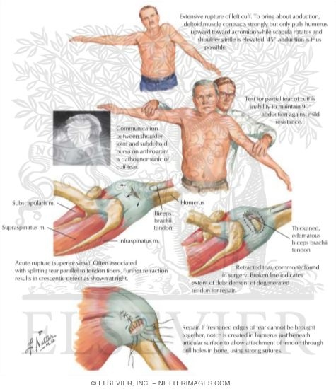 Rotator Cuff Injury