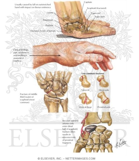 Fracture of the Scaphoid
