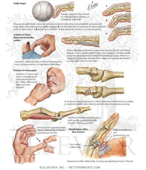Finger Injuries