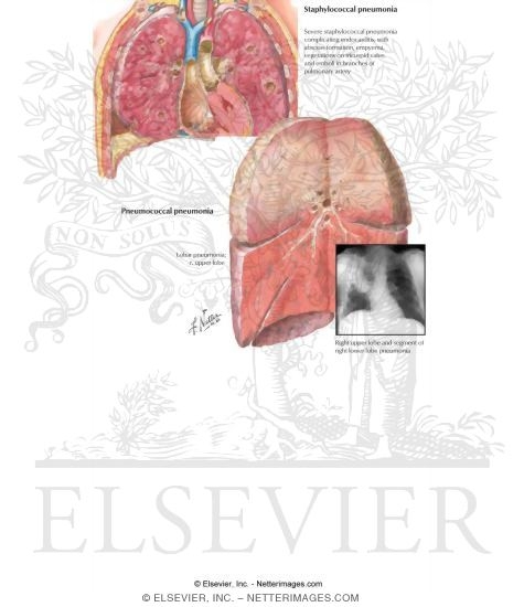 Pneumonia