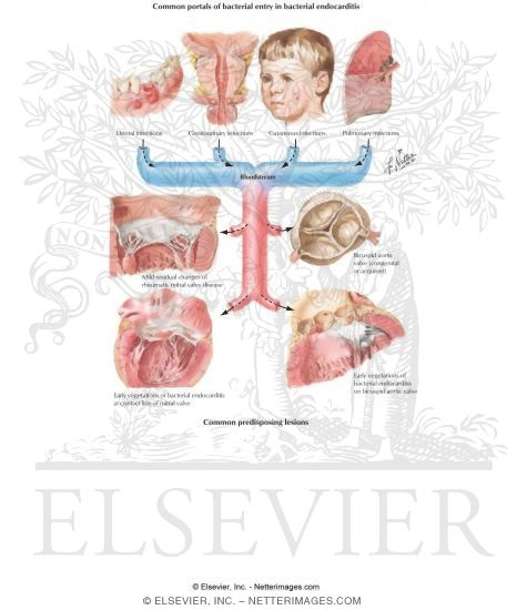 Infective Endocarditis