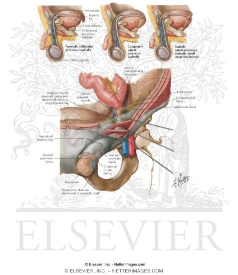 Abdominal Wall: Inguinal Hernia