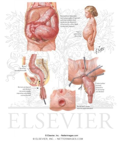Congenital Megacolon