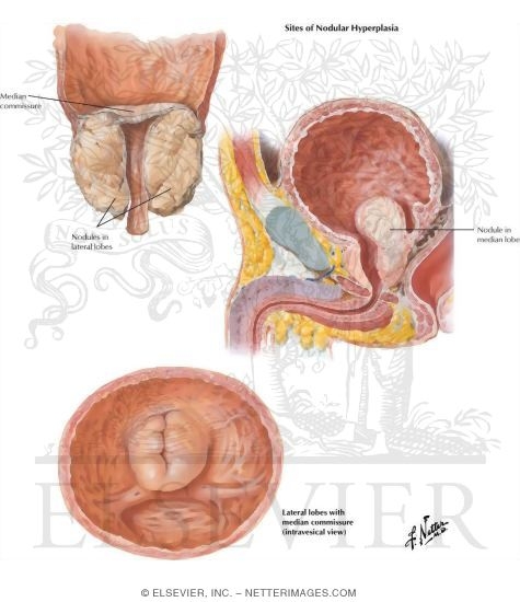 Benign Prostatic Hypertrophy II