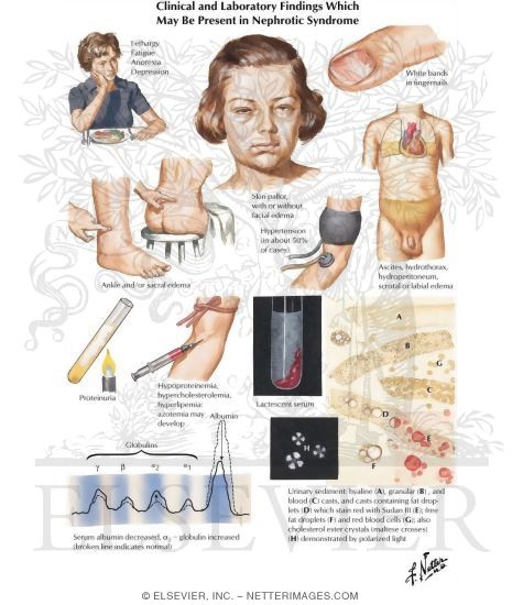 Clinical and Laboratory Findings Which May Be Present in Nephrotic Syndrome